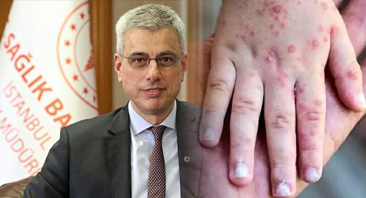 Ankara’da “Maymun Çiçeği” karantinası iddialarına yanıt