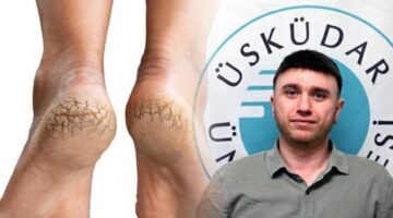 Topuk çatlağını göz ardı etmeyin, enfeksiyonlara davetiye çıkarıyor!
