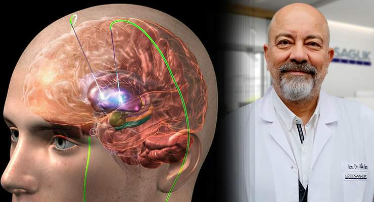 Parkinson hastalığı tedavisinde “Beyin Pili” yöntemi