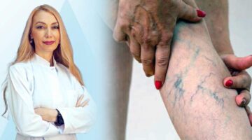 Uzman Dr. Arzu Ercan, “Bacaklarda geçmeyen şişlik ve ağrılara dikkat”